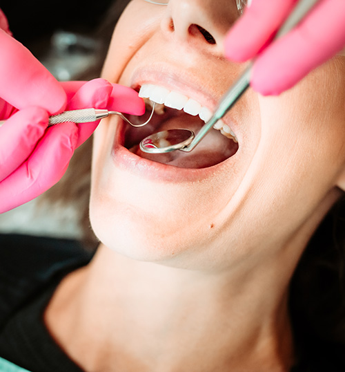 Dental Cleaning - Dental Services